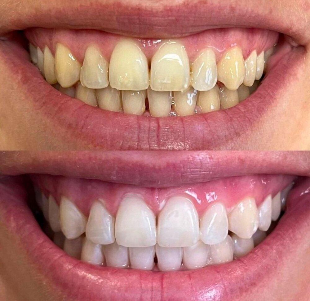 Blanqueamiento Dental Laser 1