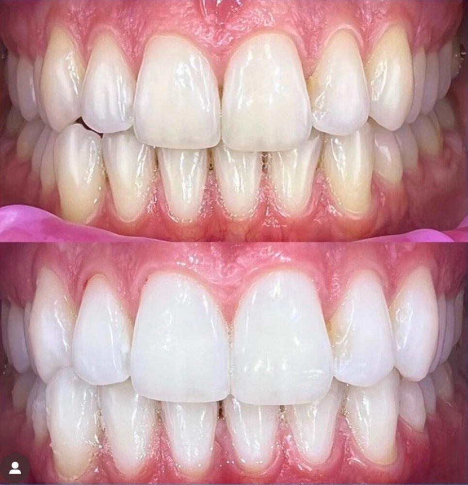 Blanqueamiento Dental Laser 2