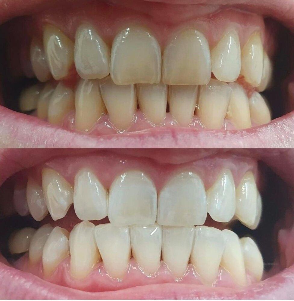 Blanqueamiento Dental Laser 6