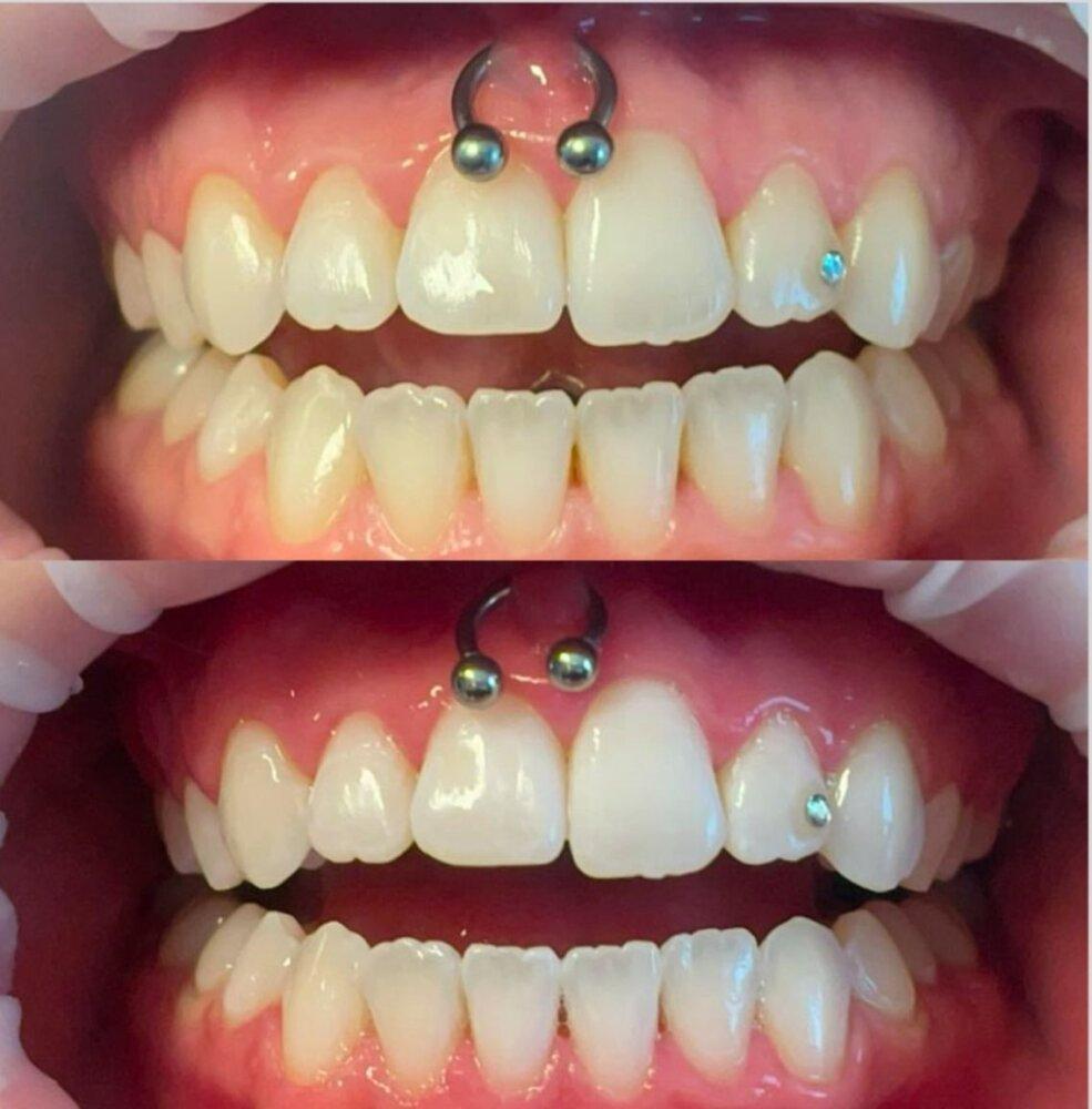 Blanqueamiento Dental Laser 3