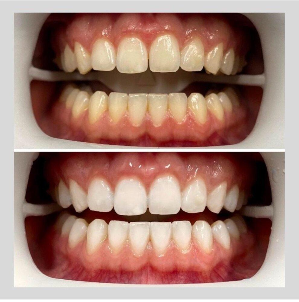 Blanqueamiento Dental Laser 5
