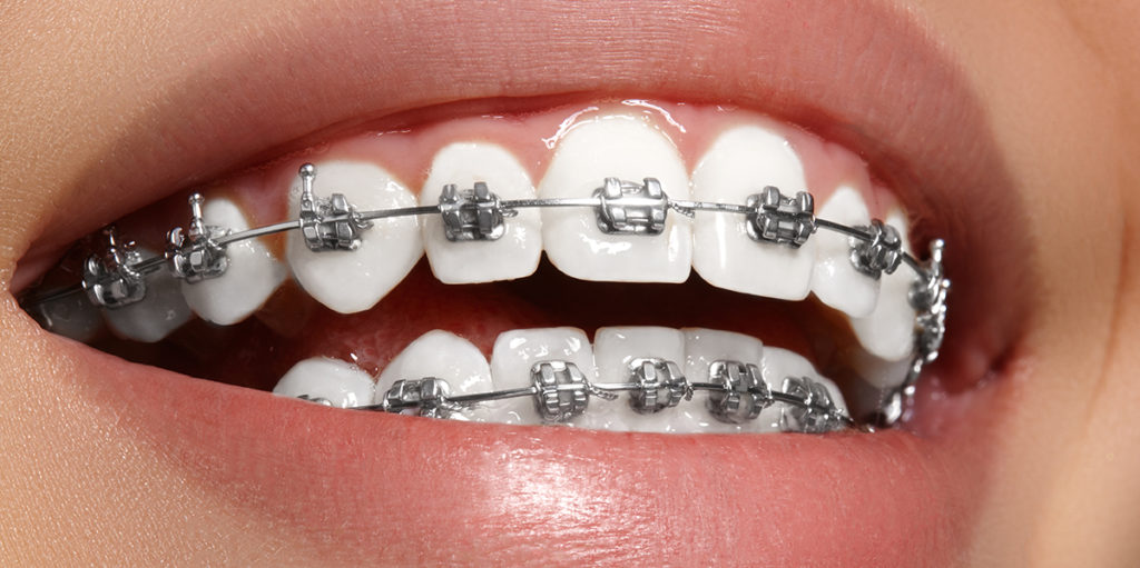 cuidar-los-dientes-durante-tratamiento-ortodoncia