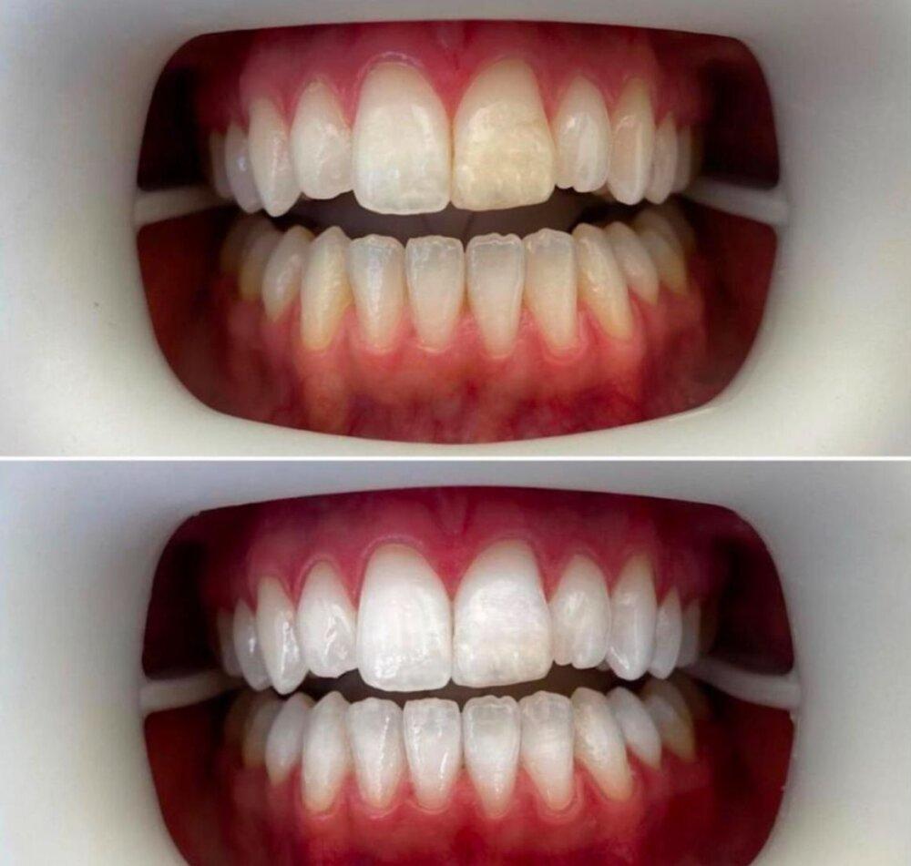 Blanqueamiento Dental Laser 4